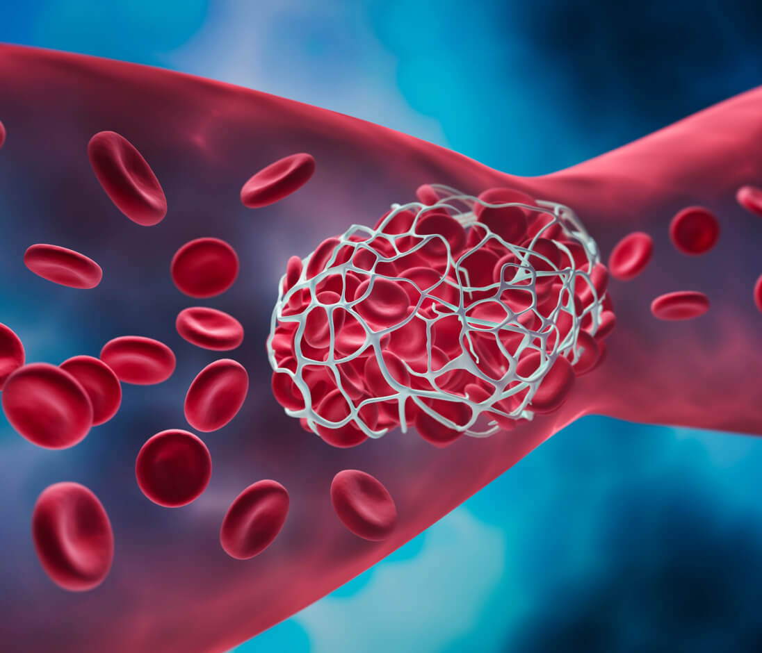 blood clot