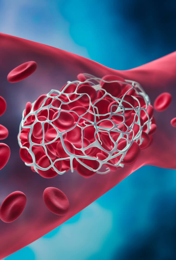 blood clot