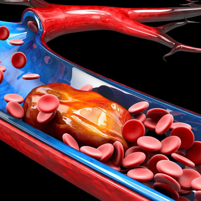 pulmonary embolism