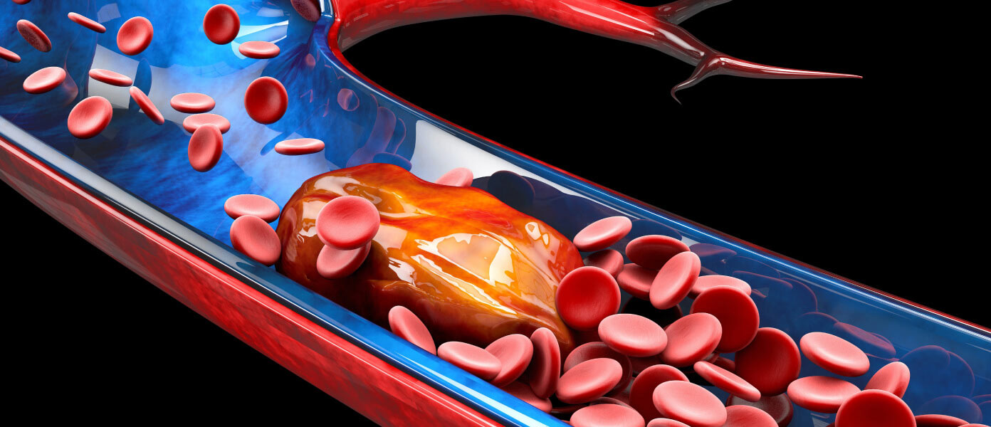 pulmonary embolism