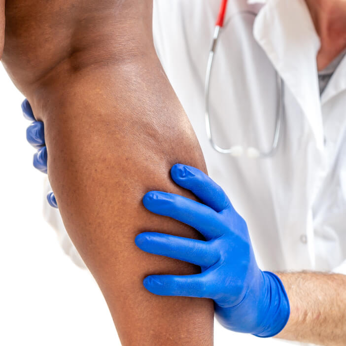 varicose veins