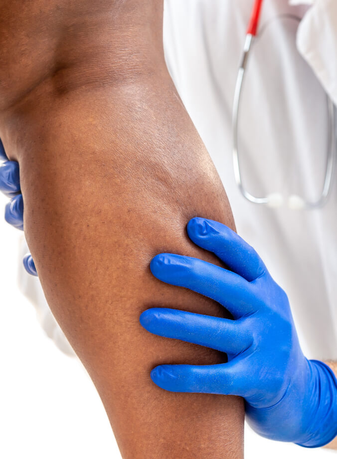 varicose veins
